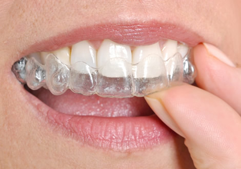 invisalign2.jpg